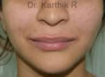 Dermal Fillers