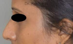 Dermal Fillers