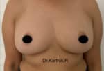 Breast Fat Fill (Breast Augmentation)