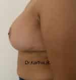 Breast Fat Fill (Breast Augmentation)