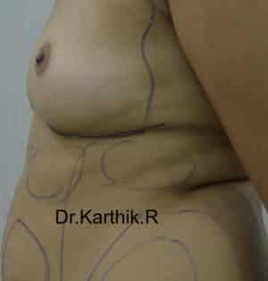 Breast Fat Fill (Breast Augmentation)