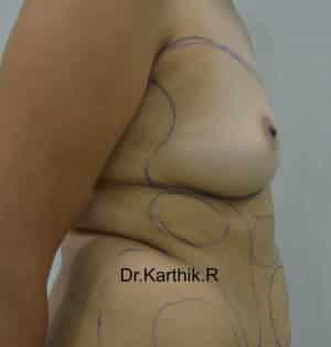 Breast Fat Fill (Breast Augmentation)