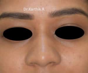 Rhinoplasty (Nose Corrections)