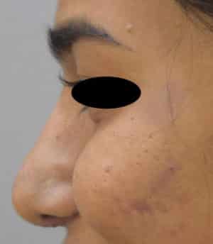 Rhinoplasty (Nose Corrections)