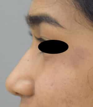 Rhinoplasty (Nose Corrections)