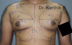 Gynecomastia (Puffy Nipples/ Male Chest Correction)