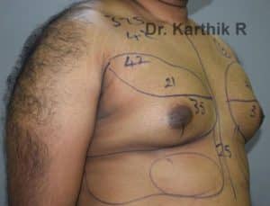 Gynecomastia (Puffy Nipples/ Male Chest Correction)