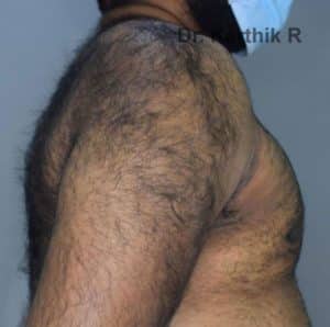 Gynecomastia (Puffy Nipples/ Male Chest Correction)