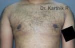 Gynecomastia (Puffy Nipples/ Male Chest Correction)