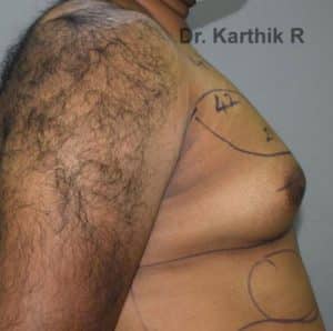 Gynecomastia (Puffy Nipples/ Male Chest Correction)