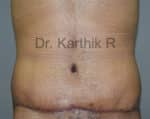 Tummy Tuck