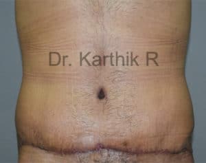Tummy Tuck
