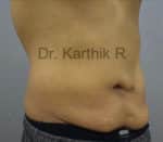 Tummy Tuck