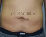 Tummy Tuck