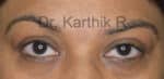 Blepharoplasty