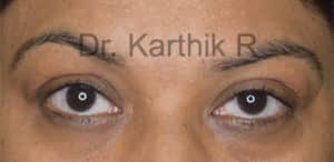 Blepharoplasty