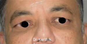 Blepharoplasty