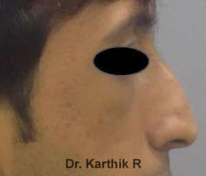 Rhinoplasty (Nose Corrections)