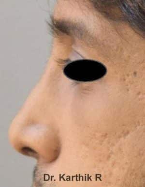 Rhinoplasty (Nose Corrections)