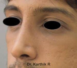 Rhinoplasty (Nose Corrections)