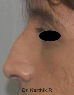 Rhinoplasty (Nose Corrections)