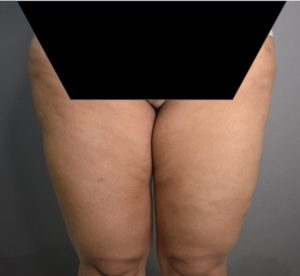 Vaser Liposuction