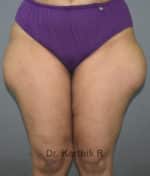 Liposuction Thighs