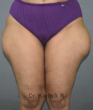 Liposuction Thighs