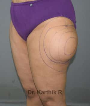 Liposuction Thighs