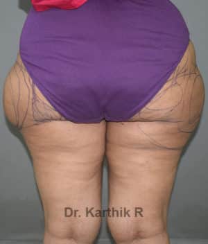 Liposuction Thighs