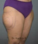 Liposuction Thighs