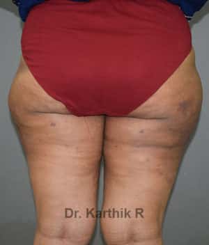 Liposuction Thighs