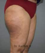 Liposuction Thighs