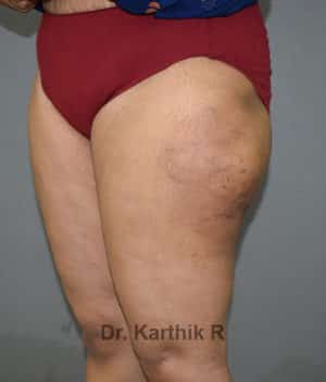Liposuction Thighs