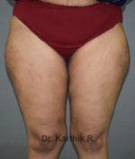 Liposuction Thighs