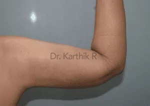 Liposuction Arms and Arm Tuck