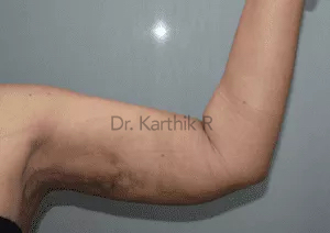 Liposuction Arms and Arm Tuck