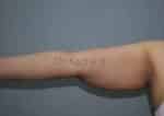 Liposuction Arms and Arm Tuck