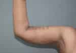 Liposuction Arms and Arm Tuck