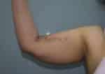 Liposuction Arms and Arm Tuck