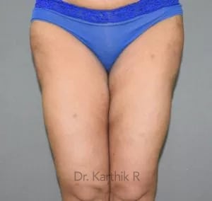 Liposuction Thighs