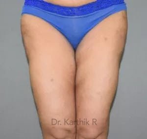 Liposuction Thighs