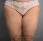 Liposuction Thighs