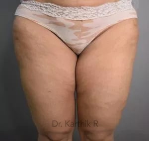 Liposuction Thighs