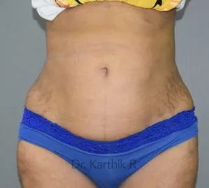 Liposuction Tummy and Back