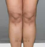 Liposuction Calf