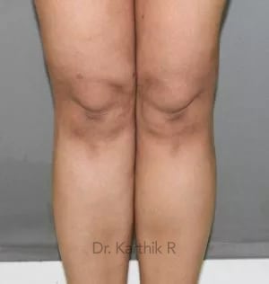 Liposuction Calf