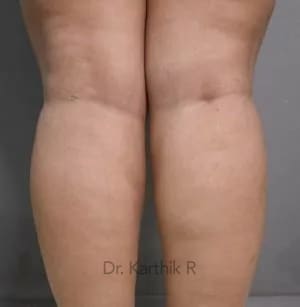 Liposuction Calf