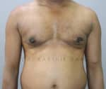 Gynecomastia (Puffy Nipples/ Male Chest Correction)