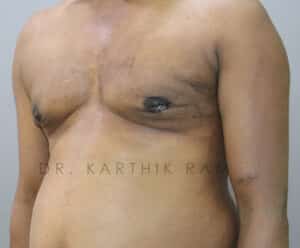 Gynecomastia (Puffy Nipples/ Male Chest Correction)